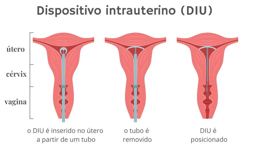 colocação do diu